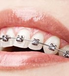 יישור שיניים - תמונת המחשה