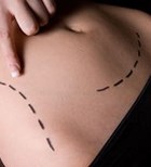 רפואה אסתטית: ניתוח שאיבת שומן-תמונה
