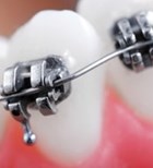 אורתודונטיה: כל הדרכים ליישור שיניים