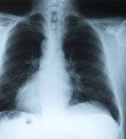 חומצות שומן אומגה-3 משפרות תפקוד ריאתי בחולי COPD (מתוך Chest)