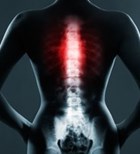 כורדומה: גידול סרטני בעמוד השדרה