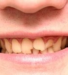 שיניים שבורות - יש פתרונות (אילוסטרציה shutterstock)