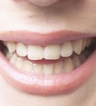 השתלות שיניים ופה מחייך