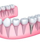 השתלות שיניים והשתלת עצם הלסת (אילוסטרציה)