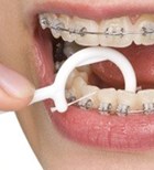 יישור שיניים למבוגרים (אילוסטרציה)