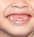 אורתודנטיה: יישור שיניים לילדים-תמונה