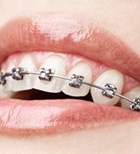 יישור שיניים: גם למבוגרים-תמונה