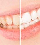 הלבנת שיניים: בדרך לחיוך נוצץ-תמונה
