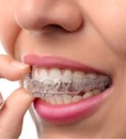 יישור שיניים שקוף: Invisalign