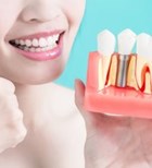 השתלת שיניים: כל האמת בפה מלא-תמונה