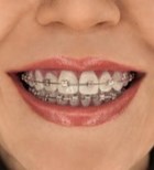 יישור שיניים: יותר יעיל, פחות בולט-תמונה