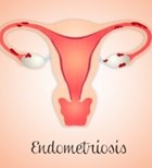 אנדומטריוזיס: סובלת - ולא מצליחה ללדת? אנדומטריוזיס: סובלת - ולא מצליחה ללדת?