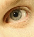 קרטוקונוס: מחלת עיניים ים תיכונית