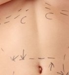 בודי ליפט אחרי דיאטה: לעור שלום-תמונה בודי ליפט אחרי דיאטה: לעור שלום-תמונה