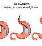 הרזיה: בלון קיבה במקום ניתוח-תמונה הרזיה: בלון קיבה במקום ניתוח-תמונה