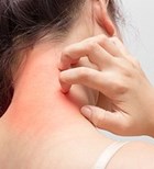 דלקת עור ממגע: איך מטפלים?