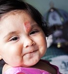 המנגיומה: גידולים שפירים של כלי דם-תמונה המנגיומה: גידולים שפירים של כלי דם-תמונה