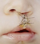 שפה וחך שסועים: מאחים את הקרע-תמונה שפה וחך שסועים: מאחים את הקרע-תמונה