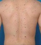 מלנומה: גילוי מוקדם מציל חיים-תמונה מלנומה: גילוי מוקדם מציל חיים-תמונה