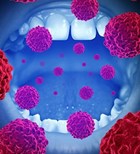 סרטן הפה - תמונת המחשה