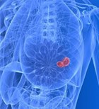 סרטן השד: רפואה מותאמת אישית-תמונה
