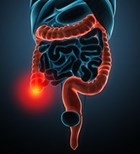 מדריך: סרטן המעי הגס (אילוסטרציה shutterstock) מדריך: סרטן המעי הגס (אילוסטרציה shutterstock)