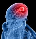 מלנומה גרורתית במוח: מהפכה בטיפול-תמונה