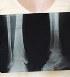 אוסטיאופורוזיס: מניעה, אבחון וטיפול-תמונה אוסטיאופורוזיס: מניעה, אבחון וטיפול-תמונה