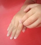 אקזמה בכף היד: ההשפעה הנפשית-תמונה אקזמה בכף היד: ההשפעה הנפשית-תמונה