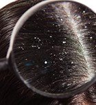 קשקשת בעור - תמונת המחשה קשקשת בעור - תמונת המחשה