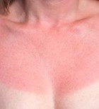 כוויות שמש - תמונת אווירה כוויות שמש - תמונת אווירה