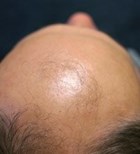 התקרחות (אילוסטרציה) התקרחות (אילוסטרציה)