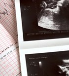 מומים בעובר: הפלות והפסקת הריון-תמונה
