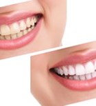 הלבנת שיניים בשעה אחת-תמונה