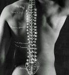 עקמת עמוד השדרה  Scoliosis-תמונה