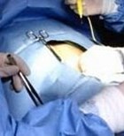 בקע (שבר) חוזר- RECURRENT HERNIA-תמונה בקע (שבר) חוזר- RECURRENT HERNIA-תמונה