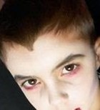 נגעי כלי דם מולדים-תמונה נגעי כלי דם מולדים-תמונה