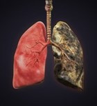מחלות ריאה: בגלל העישון-תמונה