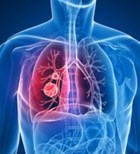 סרטן ריאה: גילוי מוקדם - מציל חיים