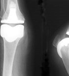 הקשר בין אקזמה לאוסטיאופורוזיס-תמונה הקשר בין אקזמה לאוסטיאופורוזיס-תמונה