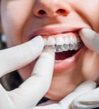 כסוף, שקוף או בלתי נראה? הכל על שיטות ליישור שיניים-תמונה כסוף, שקוף או בלתי נראה? הכל על שיטות ליישור שיניים-תמונה