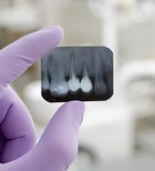 צילום שיניים פנימי - תמונת המחשה