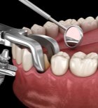 המדריך המלא לטיפולי השתלות שיניים בהעמסה מיידית -תמונה