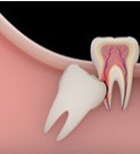 המדריך השלם לפגיעה עצבית בניתוחים לעקירת שיני בינה-תמונה