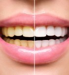 הטיפולים שיעניקו לכם שיניים לבנות -תמונה