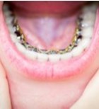 אורתודונטיה אסתטית ממוחשבת – יישור שיניים בהתאמה אישית-תמונה