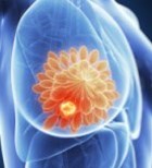 סרטן השד: גילוי מוקדם של המחלה הוא הכרח-תמונה