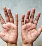 אבעבועות הקוף - מצב חירום-תמונה אבעבועות הקוף - מצב חירום-תמונה