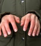 איבדתם תחושה בעור והוא מחליף צבעים? זהירות! כוויית קור-תמונה איבדתם תחושה בעור והוא מחליף צבעים? זהירות! כוויית קור-תמונה